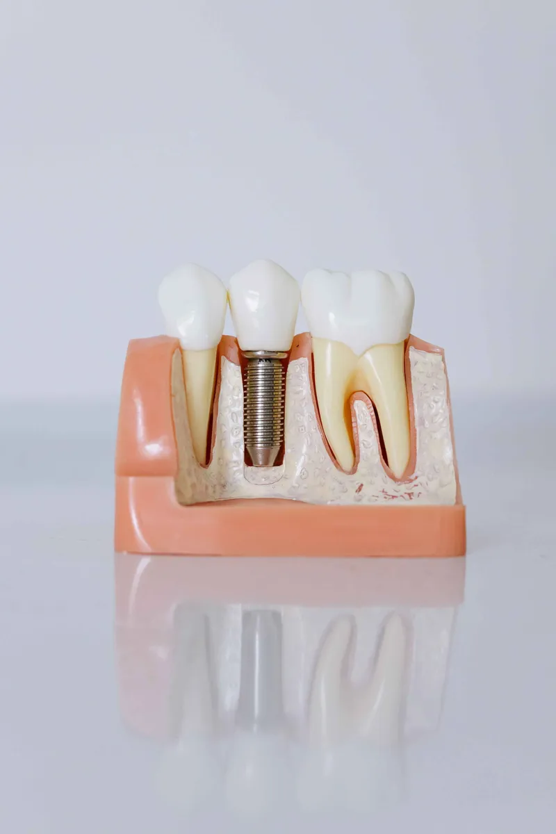 Dental İmplant